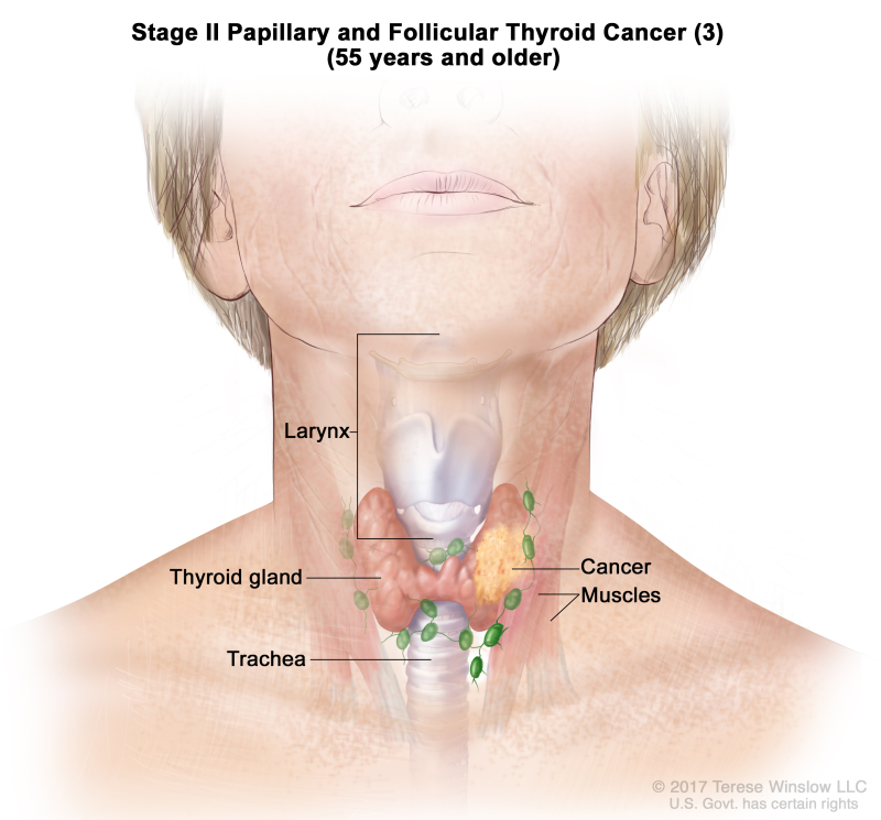 Stage II papillary and follicular thyroid cancer (3) in patients 55 years and older; drawing shows cancer in the thyroid gland and nearby muscles in the neck. Also shown are the larynx and trachea.