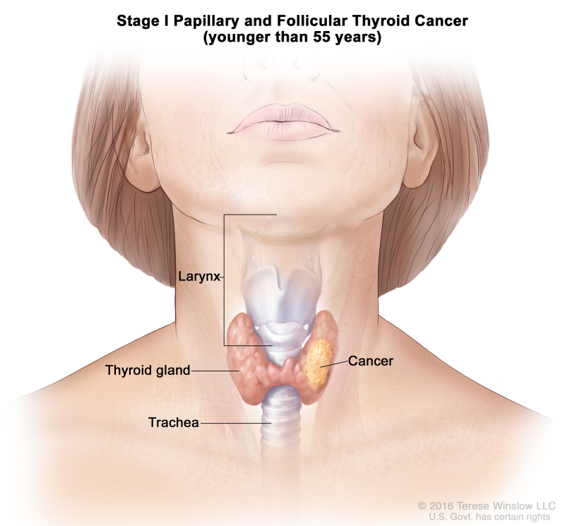 Stage I papillary and follicular thyroid cancer in patients younger than 45 years; drawing shows cancer in the thyroid gland. Also shown are the larynx and trachea.