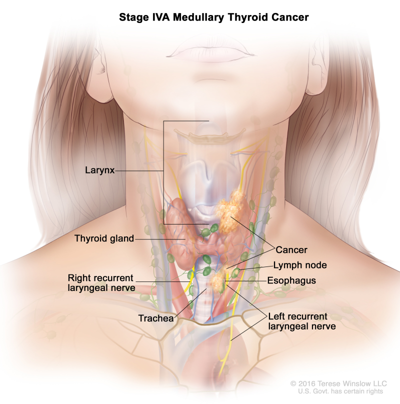 Stage IVA medullary thyroid cancer; drawing shows cancer that has spread from the thyroid gland to the larynx, the esophagus, the left recurrent laryngeal nerve, the trachea, and a lymph node on one side of the neck. Also shown is the right recurrent laryngeal nerve.