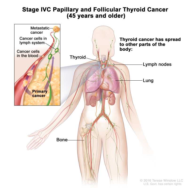 Stage IVC papillary and follicular thyroid cancer in patients 45 years and older; drawing show other parts of the body where thyroid cancer may spread, including the lymph nodes, lung, and bone. An inset shows cancer cells spreading from the thyroid, through the blood and lymph system, to another part of the body where metastatic cancer has formed.