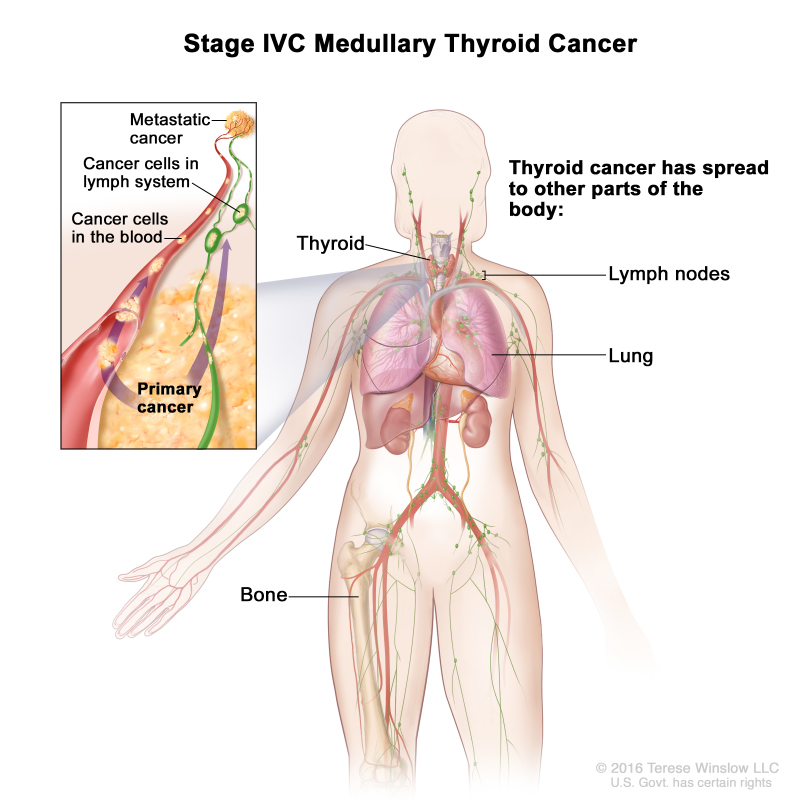 Stage IVC medullary thyroid cancer; drawing shows other parts of the body where thyroid cancer may spread, including the lymph nodes, lung, and bone. An inset shows cancer cells spreading from the thyroid, through the blood and lymph system, to another part of the body where metastatic cancer has formed.