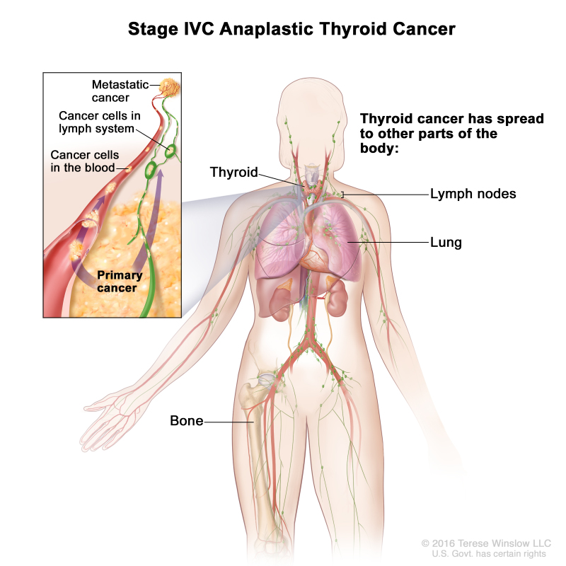 Stage IVC anaplastic thyroid cancer; drawing shows other parts of the body where thyroid cancer may spread, including the lymph nodes, lung, and bone. An inset shows cancer cells spreading from the thyroid, through the blood and lymph system, to another part of the body where metastatic cancer has formed.