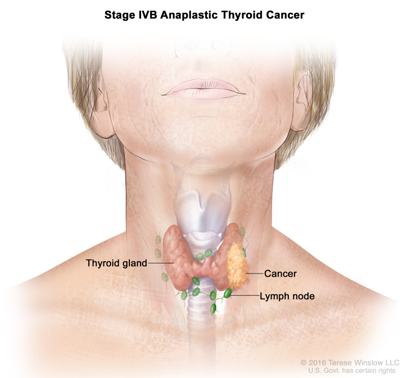 Stage IVB anaplastic thyroid cancer; drawing shows cancer that has spread to tissue just outside the thyroid gland. The lymph nodes are also shown.