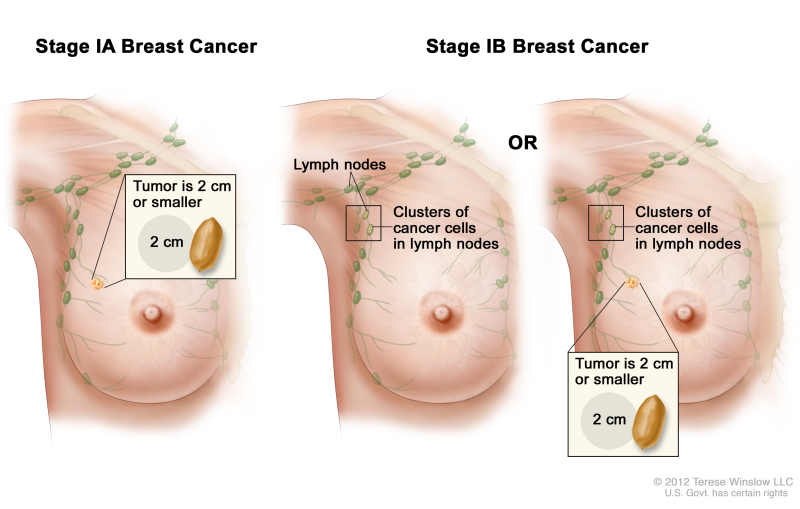 Stage I breast cancer. Drawing shows stage IA on the left; the tumor is 2 cm or smaller and has not spread outside the breast. Drawings in the middle and on the right show stage IB. In the drawing in the middle, no tumor is found in the breast, but small clusters of cancer cells are found in the lymph nodes. In the drawing on the right, the tumor is 2 cm or smaller and small clusters of cancer cells are found in the lymph nodes.