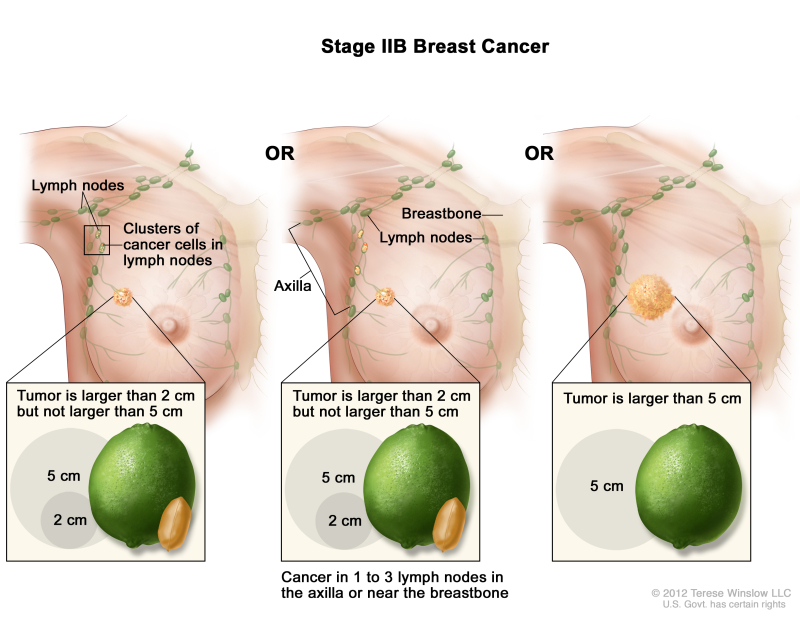 Stage IIB breast cancer. The drawing on the left shows the tumor is larger than 2 cm but not larger than 5 cm and small clusters of cancer cells are in the lymph nodes. The drawing in the middle shows the tumor is larger than 2 cm but not larger than 5 cm and cancer is in 3 axillary lymph nodes. The drawing on the right shows the tumor is larger than 5 cm but has not spread to the lymph nodes.