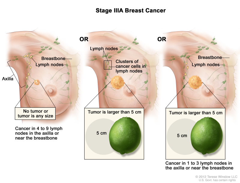 Stage IIIA breast cancer. The drawing on the left shows no tumor in the breast; cancer is found in 8 axillary lymph nodes. The drawing in the middle shows the tumor is larger than 5 cm and small clusters of cancer cells are in the lymph nodes. The drawing on the right shows the tumor is larger than 5 cm and cancer is in 3 axillary lymph nodes.