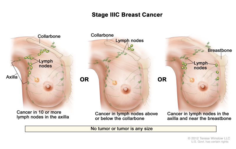 Stage IIIC breast cancer. The drawing on the left shows cancer in lymph nodes in the axilla. The drawing in the middle shows cancer in lymph nodes above the collarbone. The drawing on the right shows cancer in lymph nodes in the axilla and in lymph nodes near the breastbone.
