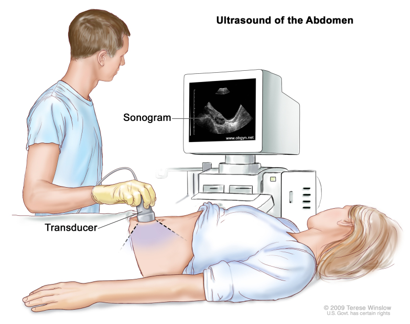 Abdominal ultrasound; drawing shows a woman on an exam table during an abdominal ultrasound procedure. A diagnostic sonographer (a person trained to perform ultrasound procedures) is shown passing a transducer (a device that makes sound waves that bounce off tissues inside the body) over the surface of the patient’s abdomen. A computer screen shows a sonogram (computer picture).