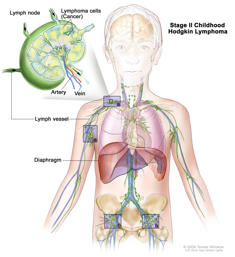 Stage II childhood Hodgkin lymphoma; drawing shows cancer in lymph node groups above and below the diaphragm. An inset shows a lymph node with a lymph vessel, an artery, and a vein. Lymphoma cells containing cancer are shown in the lymph node.