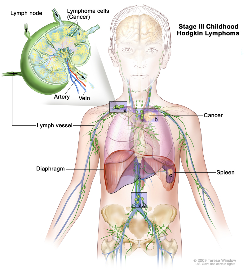 Stage III childhood Hodgkin lymphoma; drawing shows cancer in lymph node groups above and below the diaphragm, in the left lung, and in the spleen. An inset shows a lymph node with a lymph vessel, an artery, and a vein. Lymphoma cells containing cancer are shown in the lymph node.