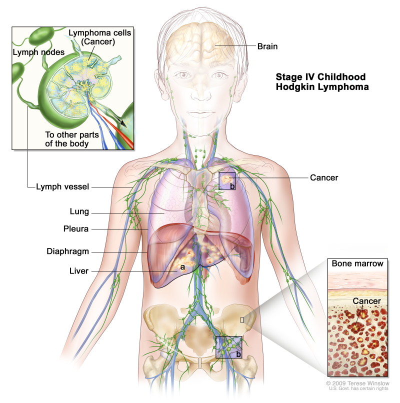 Stage IV childhood Hodgkin lymphoma; drawing shows cancer in the liver, the left lung, and in one lymph node group below the diaphragm. The brain and pleura are also shown. One inset shows cancer spreading through lymph nodes and lymph vessels to other parts of the body. Lymphoma cells containing cancer are shown inside one lymph node. Another inset shows cancer cells in the bone marrow.