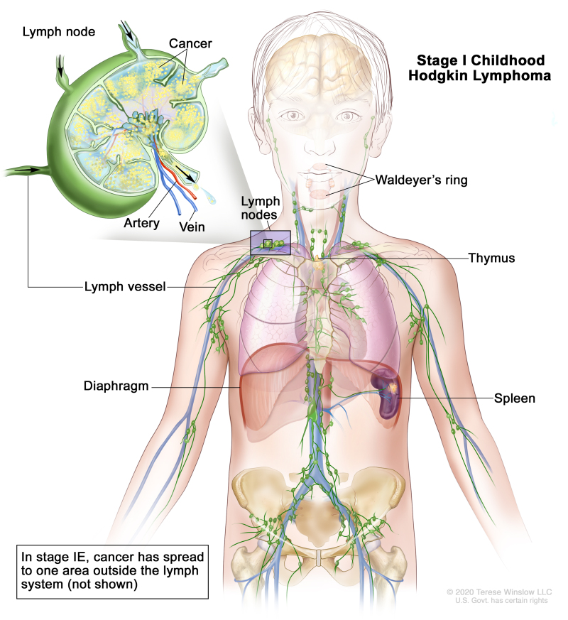 Stage I childhood Hodgkin lymphoma; drawing shows cancer in one lymph node group above the diaphragm and in the spleen. Also shown are the Waldeyer’s ring and the thymus. An inset shows a lymph node with a lymph vessel, an artery, and a vein. Cancer cells are shown inside the lymph node.