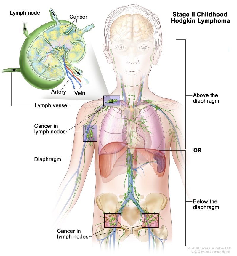 Stage II childhood Hodgkin lymphoma; drawing shows cancer in two lymph node groups above the diaphragm and below the diaphragm. An inset shows a lymph node with a lymph vessel, an artery, and a vein. Cancer cells are shown inside the lymph node.