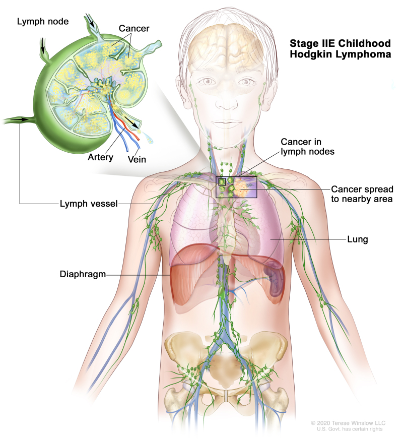 Stage IIE childhood Hodgkin lymphoma; drawing shows cancer in a lymph node group above the diaphragm and cancer that has spread to a nearby area (the left lung). An inset shows a lymph node with a lymph vessel, an artery, and a vein. Cancer cells are shown inside the lymph node.