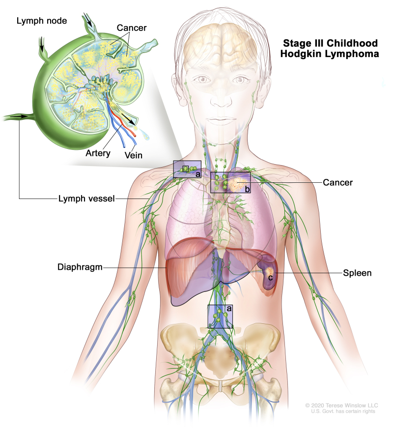 Stage III childhood Hodgkin lymphoma; drawing shows cancer in lymph node groups above and below the diaphragm (a). Also shown is cancer that has spread outside the lymph nodes to a nearby area in the left lung (b) and cancer in the spleen (c). An inset shows a lymph node with a lymph vessel, an artery, and a vein. Cancer cells are shown inside the lymph node.