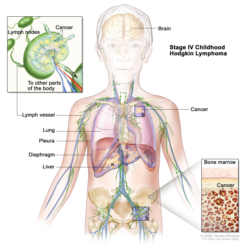 Stage IV childhood Hodgkin lymphoma; drawing shows cancer in the liver (a) the left lung (b), and in one lymph node group below the diaphragm (b). The brain and pleura are also shown. An inset on the left shows cancer cells inside a lymph node and cancer spreading through lymph nodes and lymph vessels to other parts of the body. An inset on the right shows cancer cells in the bone marrow.