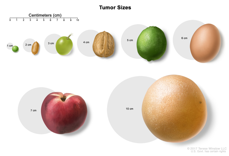 Tumor sizes; drawing shows different sizes of a tumor compared to the size of a pea (1 cm), peanut (2 cm), grape (3 cm), walnut (4 cm), lime (5 cm), egg (6 cm), peach (7 cm), and grapefruit (10 cm).