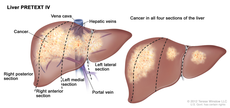 Liver PRETEXT IV; drawing shows two livers. Dotted lines divide each liver into four vertical sections that are about the same size. In the first liver, cancer is shown across all four sections. In the second liver, cancer is shown in the two sections on the left and spots of cancer are shown in the two sections on the right.