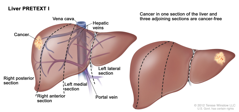 Liver PRETEXT I; drawing shows two livers. Dotted lines divide each liver into four vertical sections of about the same size. In the first liver, cancer is shown in the section on the far left. In the second liver, cancer is shown in the section on the far right.