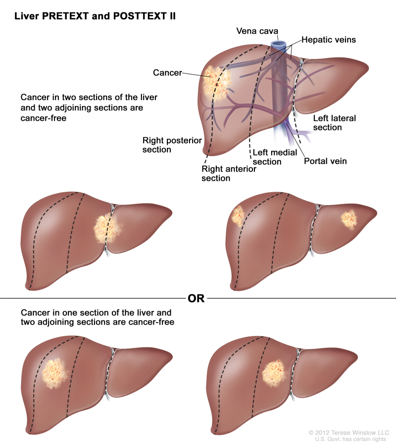 Liver PRETEXT and POSTTEXT II; drawing shows five livers. Dotted lines divide each liver into four vertical sections that are about the same size. In the first liver, cancer is shown in the two sections on the left. In the second liver, cancer is shown in the two sections on the right. In the third liver, cancer is shown in the far left and far right sections. In the fourth liver, cancer is shown in the second section from the left. In the fifth liver, cancer is shown in the second section from the right.