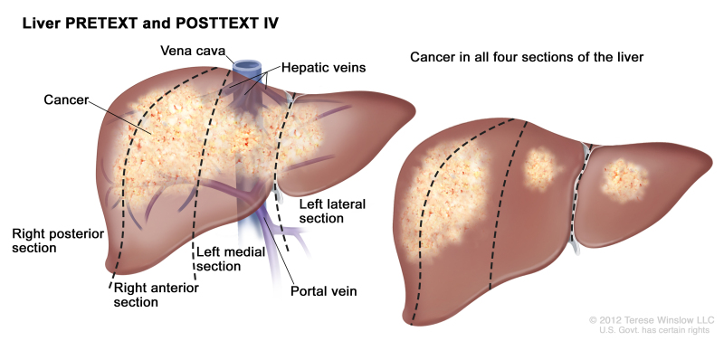 Liver PRETEXT and POSTTEXT IV; drawing shows two livers. Dotted lines divide each liver into four vertical sections that are about the same size. In the first liver, cancer is shown across all four sections. In the second liver, cancer is shown in the two sections on the left and spots of cancer are shown in the two sections on the right.