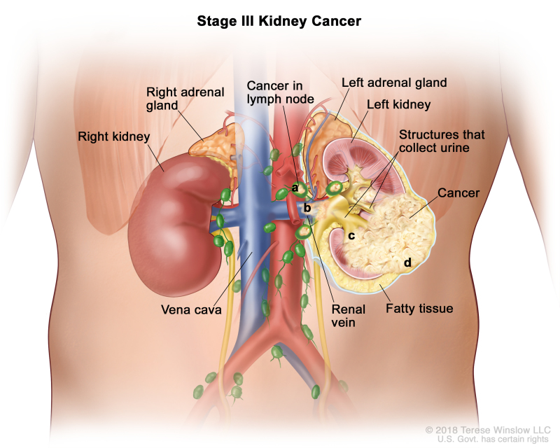 Stage III kidney cancer; drawing shows cancer in the left kidney and in a) nearby lymph nodes, b) the renal vein, c) the structures in the kidney that collect urine, and d) the layer of fatty tissue around the kidney. Also shown are the right kidney, vena cava, and right and left adrenal glands.