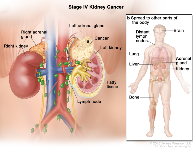 Stage IV kidney cancer; drawing shows cancer that has spread beyond the layer of fatty tissue around the left kidney to a) the adrenal gland above the left kidney. Also shown are the lymph nodes, right adrenal gland, and right kidney. An inset shows b) other parts of the body where kidney cancer may spread, including the brain, lung, liver, adrenal gland, bone, and distant lymph nodes.
