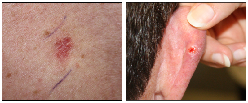 Photographs showing a skin cancer lesion that looks reddish brown and slightly raised (left panel) and the back of a person’s ear with a skin cancer lesion that looks like an open sore with a pearly rim (right panel).