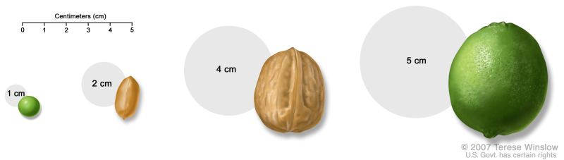 Tumor size compared to everyday objects; shows various measurements of a tumor compared to a pea, peanut, walnut, and lime.