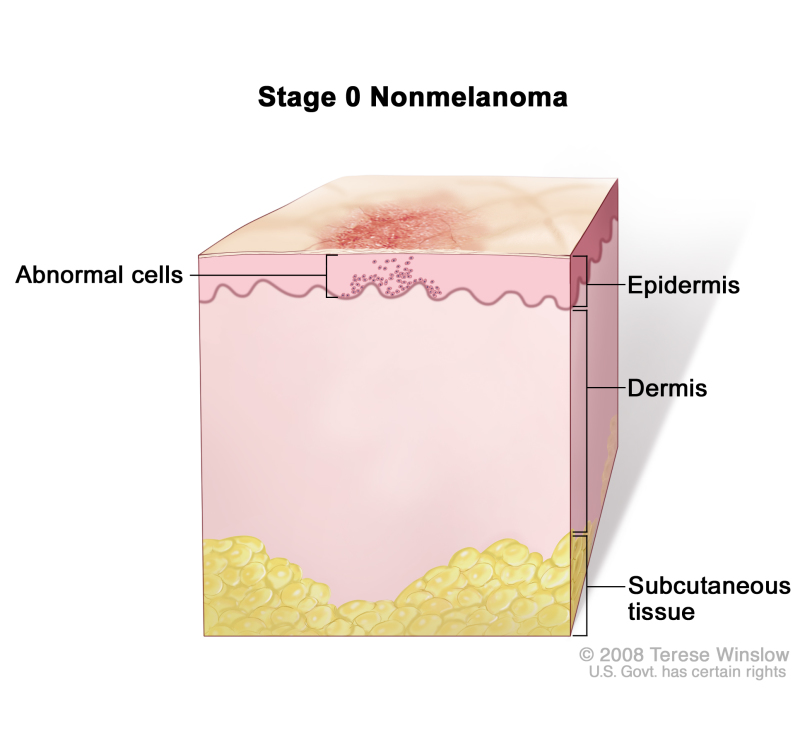Stage 0 nonmelanoma skin carcinoma in situ; drawing shows skin anatomy with abnormal cells in the epidermis (outer layer of the skin). Also shown are the dermis (inner layer of the skin) and subcutaneous tissue below the dermis.