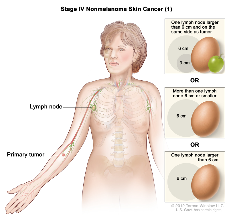Stage IV nonmelanoma skin cancer (1); drawing shows a primary tumor in one arm with cancer in a lymph node on the same side of the body as the primary tumor. Insets show 3 centimeters is about the size of a grape and 6 centimeters is about the size of an egg.