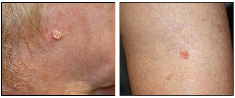 Photographs showing the side of a person’s face with a skin cancer lesion that looks raised and crusty (left panel) and a person’s leg with a skin cancer lesion that looks pink and raised (right panel).