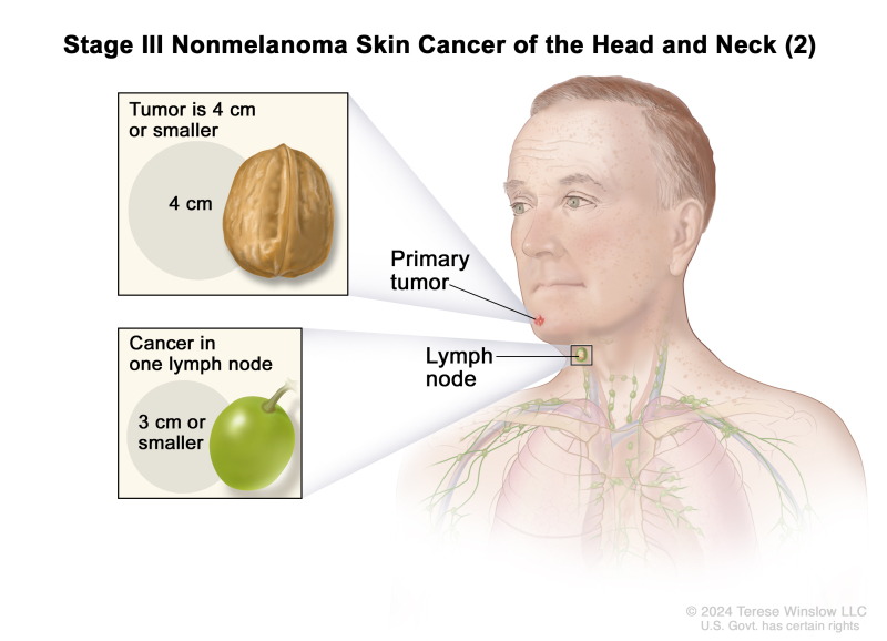 Stage III nonmelanoma skin cancer of the head and neck (2); drawing shows a primary tumor on the face and cancer in one lymph node on the same side of the body as the tumor. The top inset shows that the tumor is 4 centimeters or smaller and that 4 centimeters is about the size of a walnut. The bottom inset shows that the lymph node with cancer is 3 centimeters or smaller and that 3 centimeters is about the size of a grape.