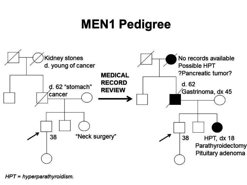 Pedigree showing some of the features of a family with a deleterious MEN1 mutation across four generations, including transmission occurring through paternal lineage. The unaffected male proband is shown as having an affected sister (self-report of neck surgery confirmed upon review of medical records to be hyperparathyroidism diagnosed at age 18 y, parathyroidectomy, and pituitary adenoma), father (self-report of stomach cancer confirmed upon review of medical records to be gastrinoma diagnosed at age 45 y), and paternal grandmother (suspected hyperparathyroidism and/or pancreatic tumor).
