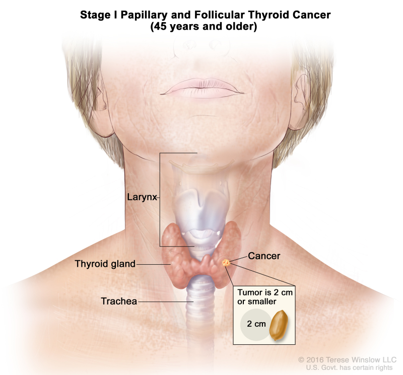 Stage I papillary and follicular thyroid cancer in patients 45 years and older; drawing shows cancer in the thyroid gland. The tumor is 2 centimeters or smaller. Also shown are the larynx and trachea.