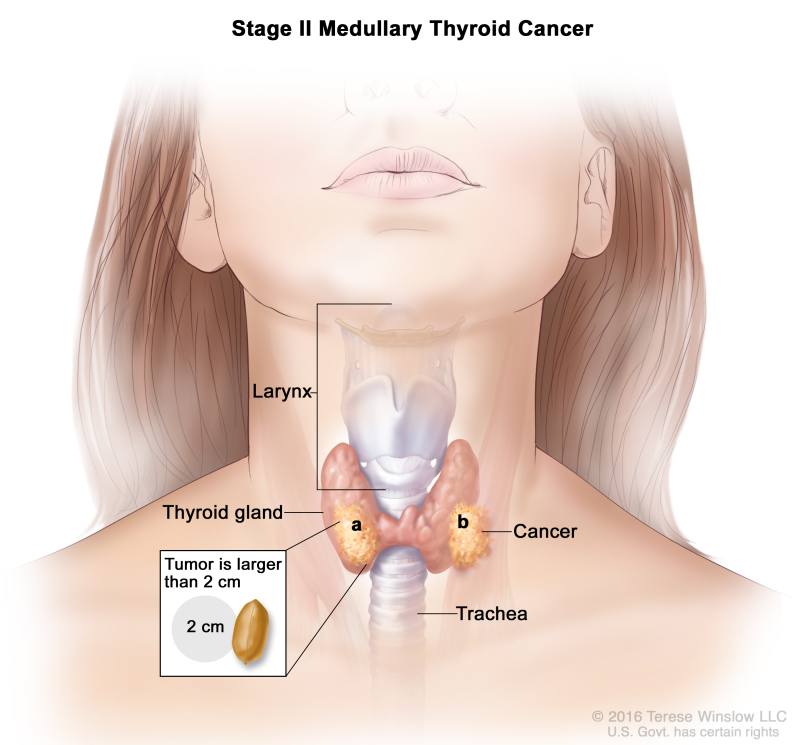 Stage II medullary thyroid cancer; drawing shows (a) cancer in the thyroid gland and the tumor is larger than 2 centimeters and (b) cancer has spread to tissues just outside the thyroid gland. Also shown are the larynx and trachea.