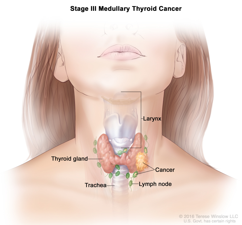 Stage III medullary thyroid cancer; drawing shows cancer that has spread to tissues just outside the thyroid gland and to lymph nodes near the trachea and larynx.