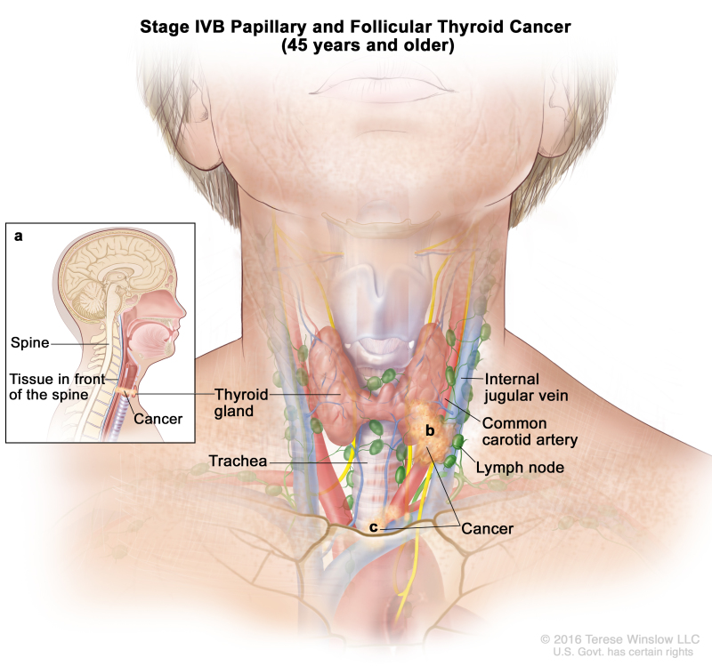 Stage IVB papillary and follicular thyroid cancer in patients 45 years and older; drawing shows cancer that has spread from the thyroid gland to tissue in front of the spine and has surrounded the common carotid artery and the blood vessels in the area between the lungs. Also shown are the internal jugular vein, lymph nodes, and trachea.