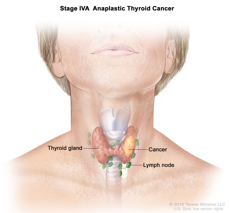 Stage IVA anaplastic thyroid cancer; drawing shows cancer in the thyroid gland. The lymph nodes are also shown.