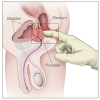 Digital rectal exam (DRE)