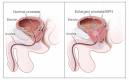 Normal prostate and benign prostatic hyperplasia (BPH)