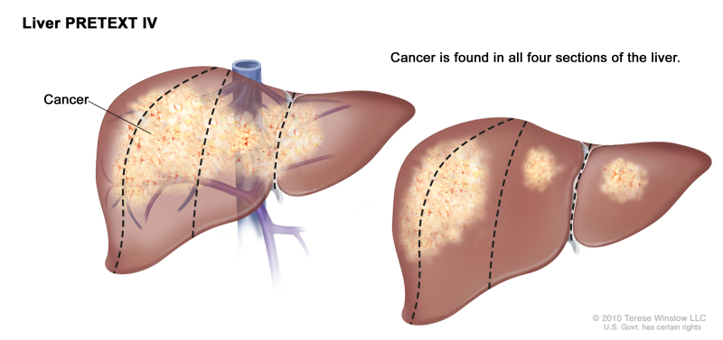 Liver PRETEXT IV; drawing shows two livers. Dotted lines divide each liver into four vertical sections that are about the same size. In the first liver, cancer is shown across all four sections. In the second liver, cancer is shown in the two sections on the left and spots of cancer are shown in the two sections on the right.