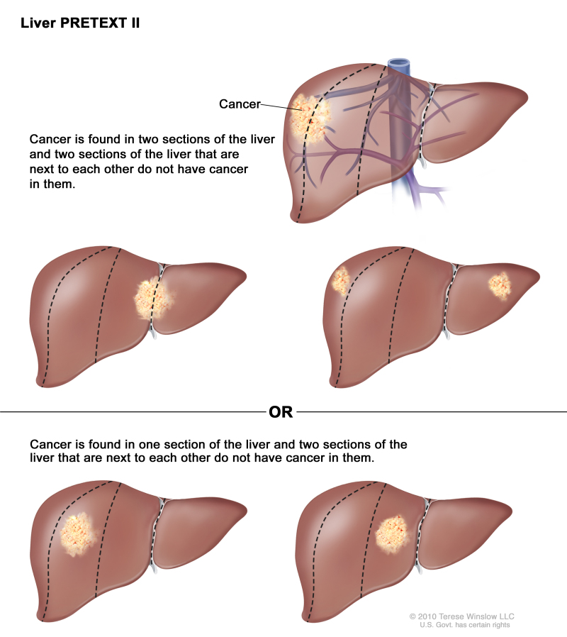 Liver PRETEXT II; drawing shows five livers. Dotted lines divide each liver into four vertical sections that are about the same size. In the first liver, cancer is shown in the two sections on the left. In the second liver, cancer is shown in the two sections on the right. In the third liver, cancer is shown in the far left and far right sections. In the fourth liver, cancer is shown in the second section from the left. In the fifth liver, cancer is shown in the second section from the right.