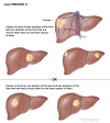 Liver PRETEXT II