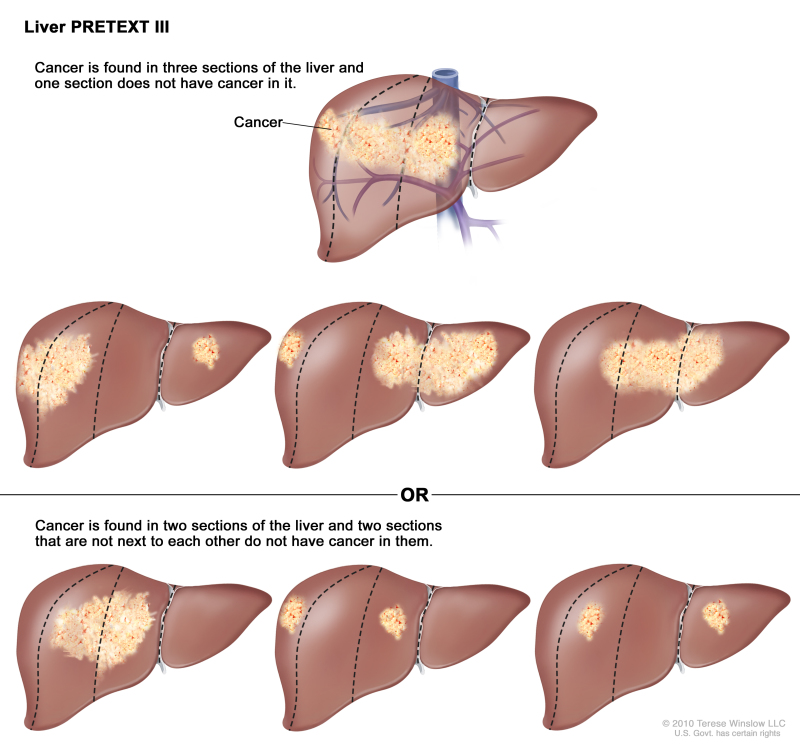 Liver PRETEXT III; drawing shows seven livers. Dotted lines divide each liver into four vertical sections that are about the same size. In the first liver, cancer is shown in three sections on the left. In the second liver, cancer is shown in the two sections on the left and the section on the far right. In the third liver, cancer is shown in the section on the far left and the two sections on the right. In the fourth liver, cancer is shown in three sections on the right. In the fifth liver, cancer is shown in the two middle sections. In the sixth liver, cancer is shown in the section on the far left and the second section from the right. In the seventh liver, cancer is shown in the section on the far right and the second section from the left.