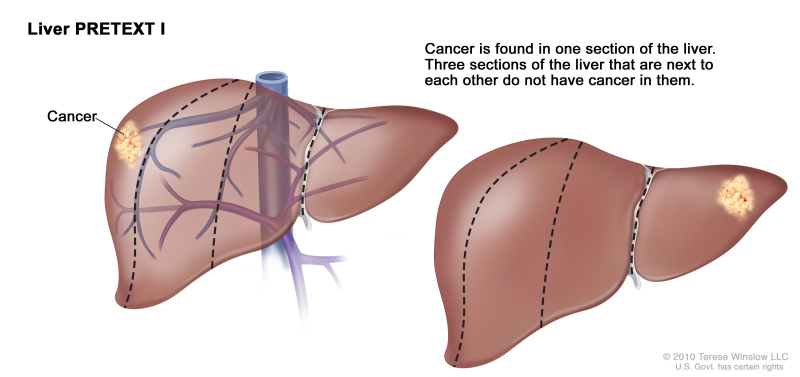 Liver PRETEXT I; drawing shows two livers. Dotted lines divide each liver into four vertical sections of about the same size. In the first liver, cancer is shown in the section on the far left. In the second liver, cancer is shown in the section on the far right.