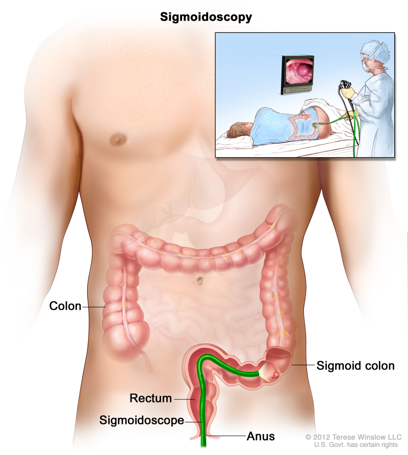 Sigmoidoscopy; shows sigmoidoscope inserted through the anus and rectum and into the sigmoid colon. Inset shows patient on table having a sigmoidoscopy.