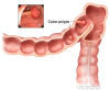 Polyps in the colon