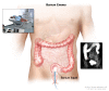 Barium enema procedure