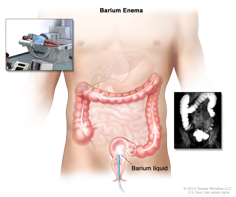 Barium enema procedure; shows barium liquid being put into the rectum and flowing through the colon. Inset shows person on table having a barium enema.